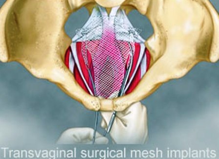 Transvaginal-surgical-mesh-implants.jpg