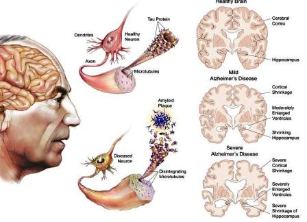 Pendarahan Di Kepala Tingkatkan Risiko Alzheimer