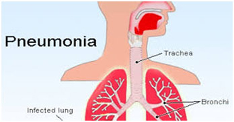 pneumonia-ils.jpg