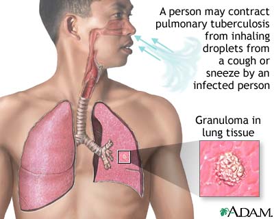 tuberculosis-of-the-lungs-picture.jpg